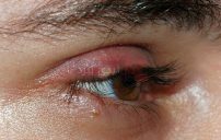 علاج التهاب جفن العين 5