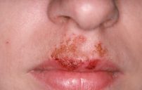 impetigo